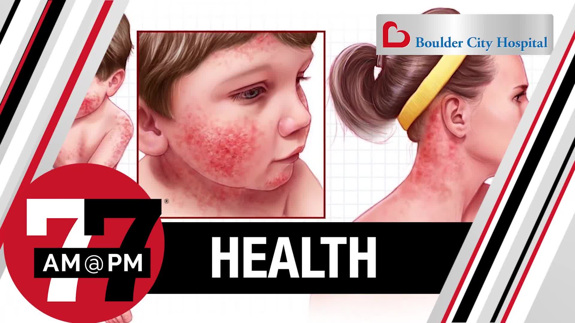 How to deal with eczema