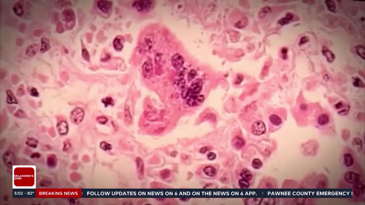 Measles cases confirmed in Oklahoma by OSDH